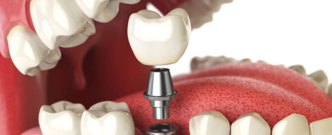 Dental Implants