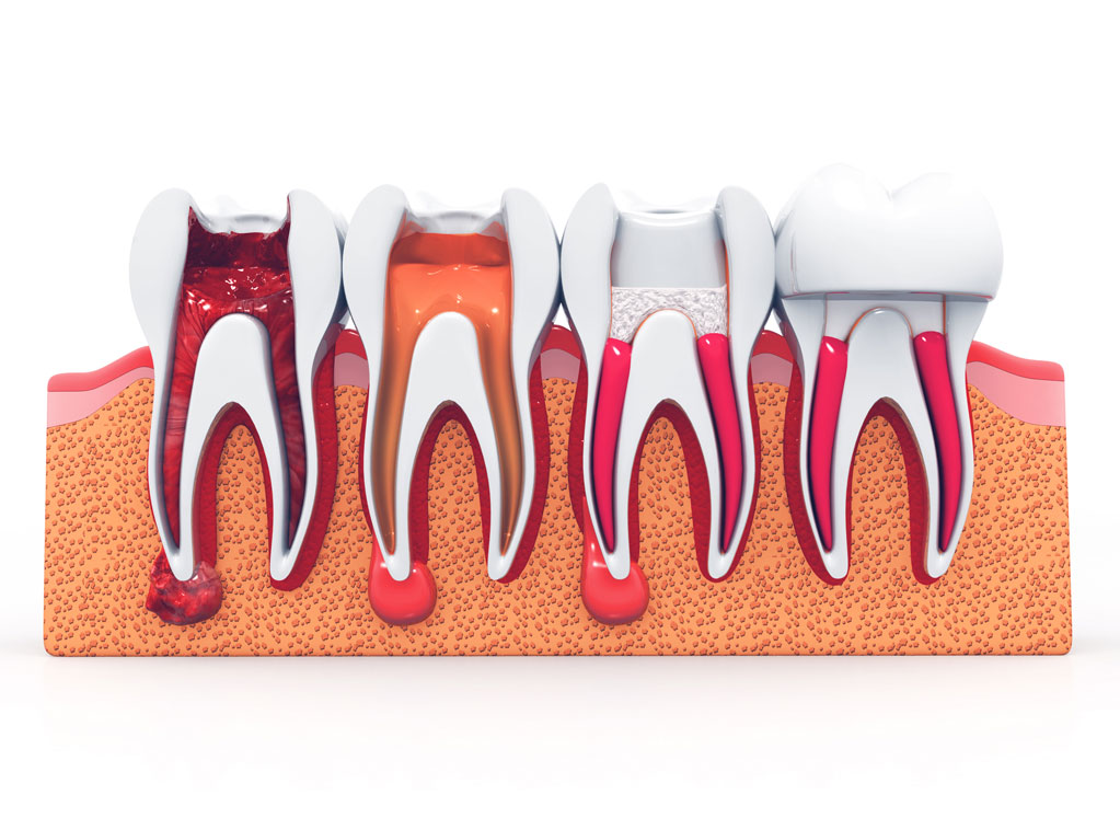 root-canal Root Canal