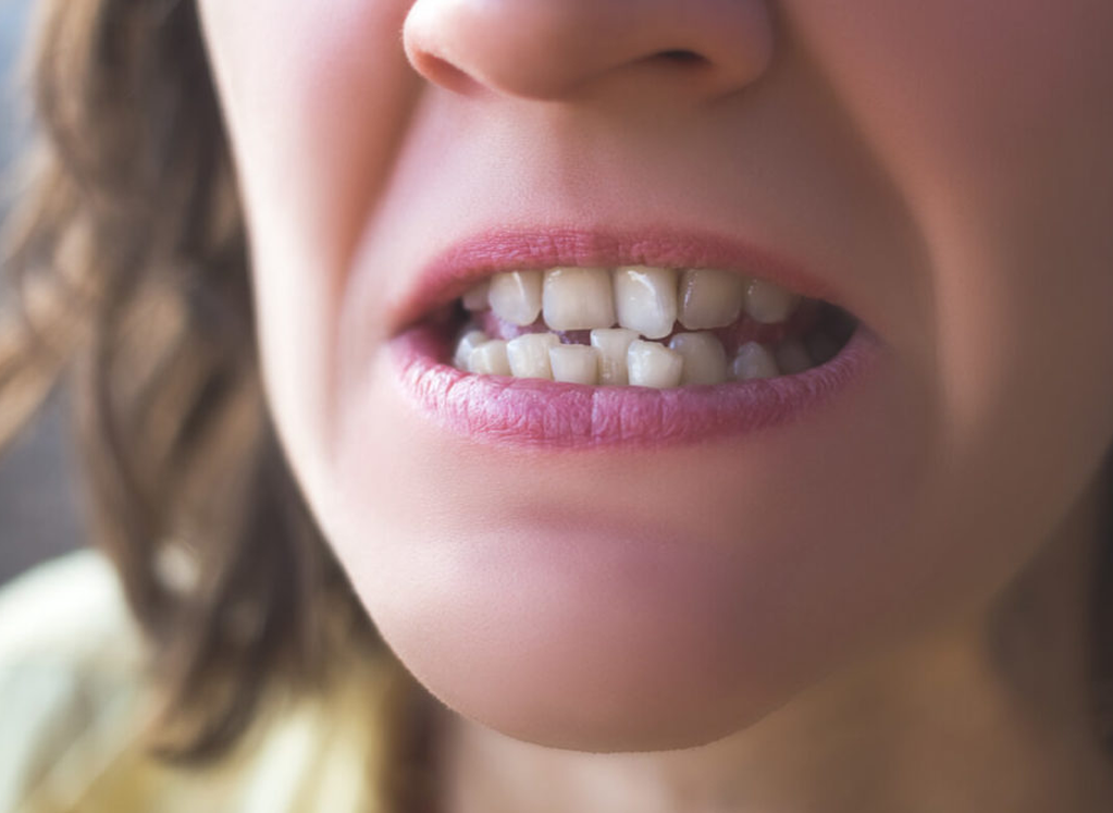 crooked-teeth